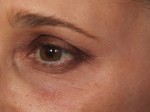 Thermage® Before and after photo