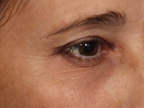 Thermage® before and after photo