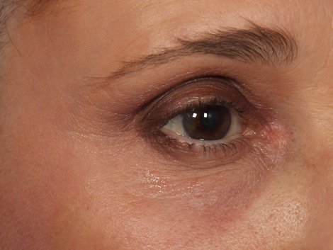 Thermage® before and after photo