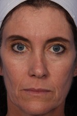 Thermage® Before and after photo