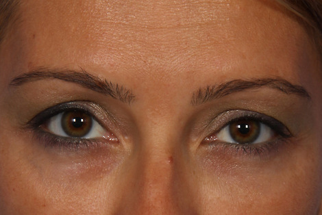 BOTOX® Cosmetic before and after photo