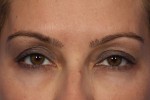 BOTOX® Cosmetic Before and after photo