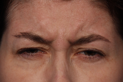 BOTOX® Cosmetic before and after photo