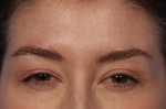 BOTOX® Cosmetic Before and after photo