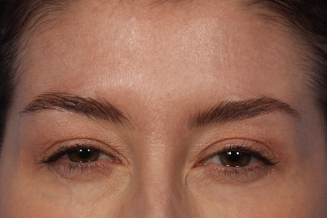 BOTOX® Cosmetic before and after photo