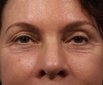 BOTOX® Cosmetic Before and after photo