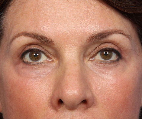 BOTOX® Cosmetic before and after photo