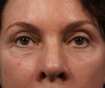 BOTOX® Cosmetic Before and after photo