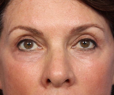 BOTOX® Cosmetic before and after photo