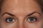 BOTOX® Cosmetic Before and after photo