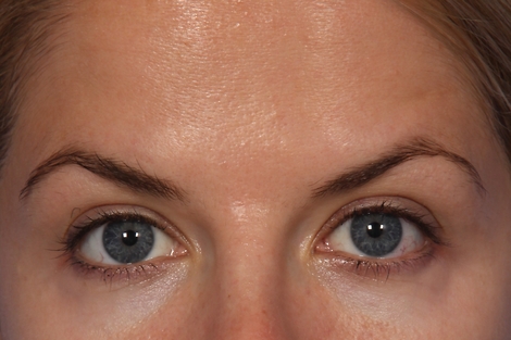 BOTOX® Cosmetic before and after photo