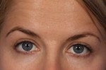 BOTOX® Cosmetic Before and after photo