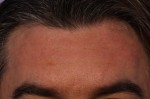 BOTOX® Cosmetic