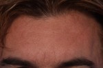 BOTOX® Cosmetic Before and after photo