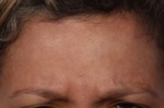 BOTOX® Cosmetic Before and after photo