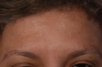 BOTOX® Cosmetic Before and after photo