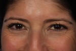 BOTOX® Cosmetic Before and after photo