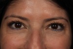 BOTOX® Cosmetic Before and after photo