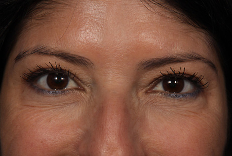 BOTOX® Cosmetic before and after photo