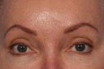 BOTOX® Cosmetic Before and after photo