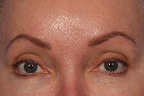 BOTOX® Cosmetic before and after photo