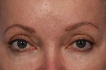 BOTOX® Cosmetic Before and after photo