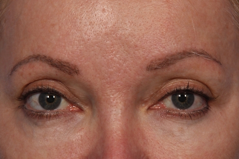 BOTOX® Cosmetic before and after photo