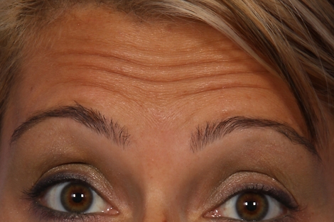 BOTOX® Cosmetic before and after photo