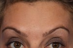 BOTOX® Cosmetic Before and after photo