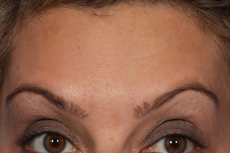 BOTOX® Cosmetic before and after photo