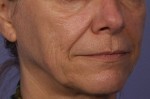 Sculptra Before and after photo