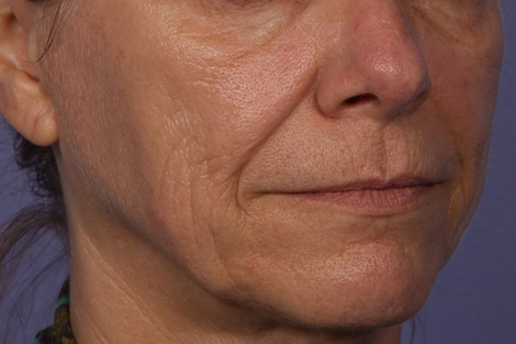 Sculptra before and after photo