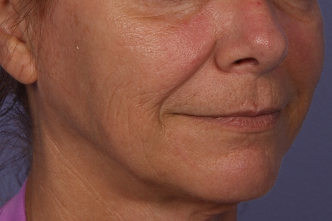 Sculptra before and after photo