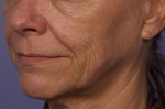 Sculptra Before and after photo