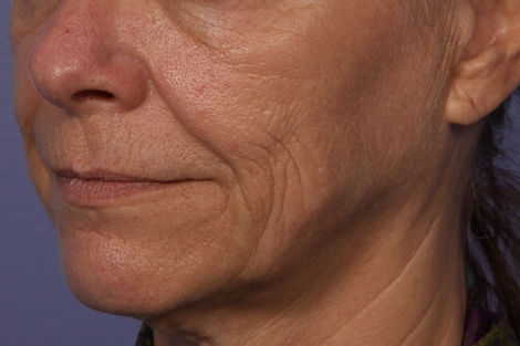 Sculptra before and after photo