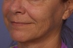 Sculptra Before and after photo