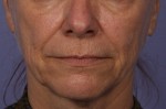 Sculptra Before and after photo