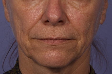 Sculptra before and after photo