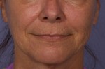 Sculptra Before and after photo
