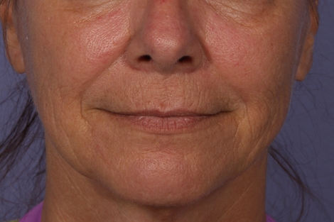 Sculptra before and after photo