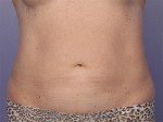 CoolSculpting® Before and after photo