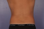 CoolSculpting® Before and after photo