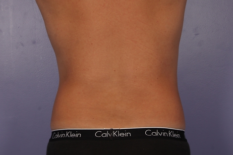 CoolSculpting® before and after photo