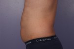 CoolSculpting® Before and after photo