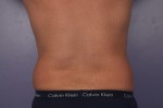 CoolSculpting® Before and after photo