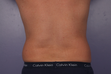 CoolSculpting® before and after photo