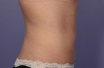 CoolSculpting® Before and after photo