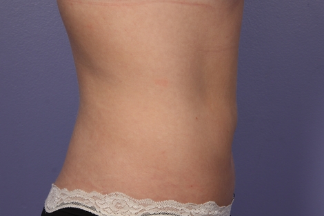 CoolSculpting® before and after photo