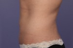 CoolSculpting® Before and after photo