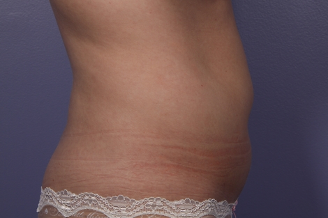 CoolSculpting® before and after photo